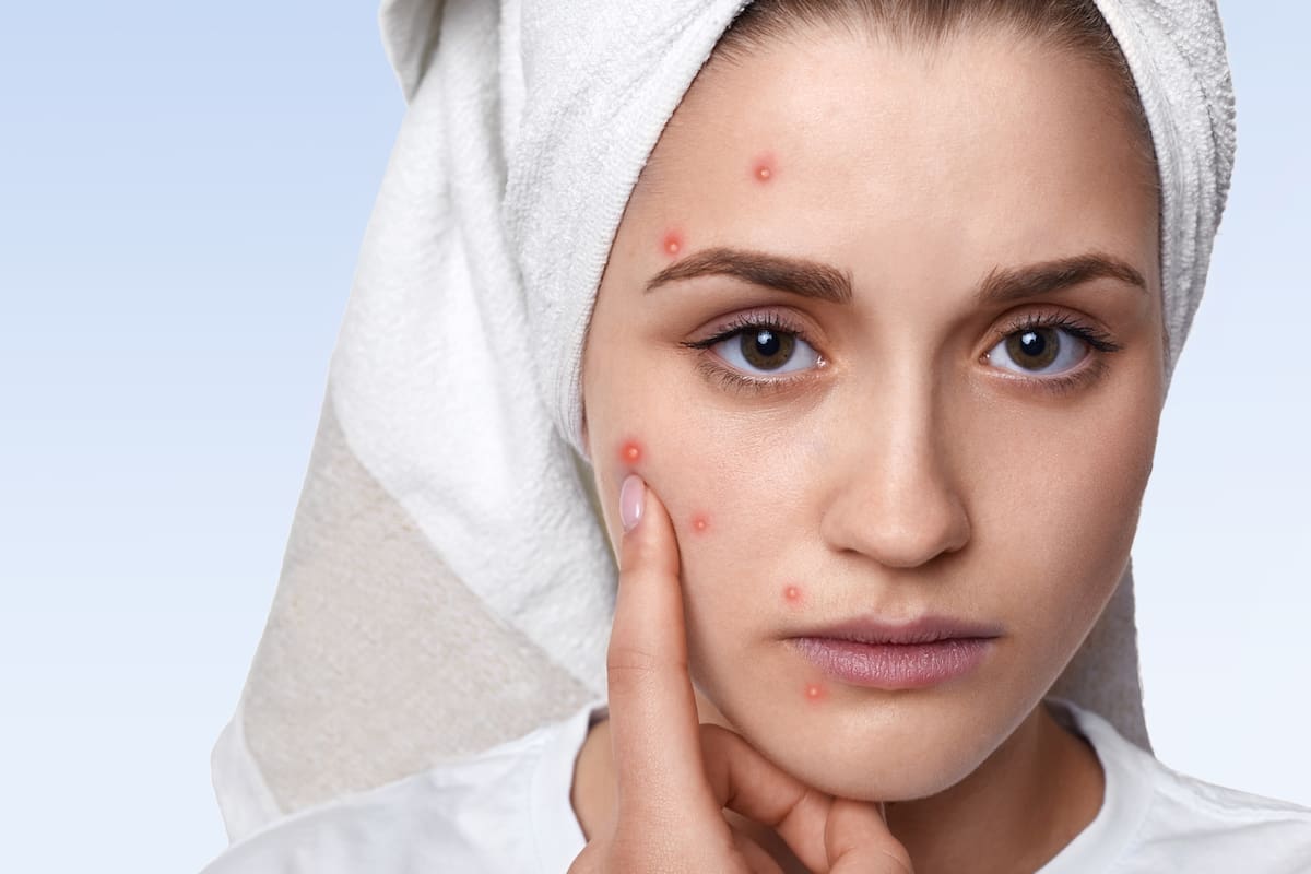 ¿Funcionan los parches para granos? Esto dicen los dermatólogos