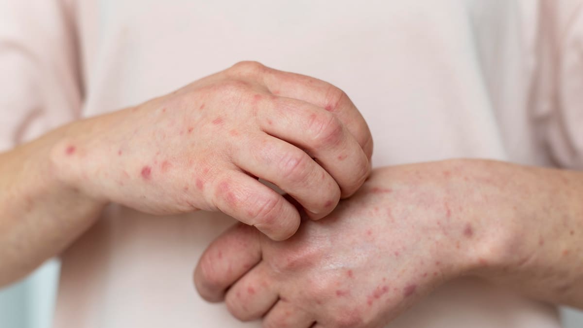 Casos de sarampión superan los mil en EEUU por tercera vez en 26 años: qué está pasando y cómo protegerse