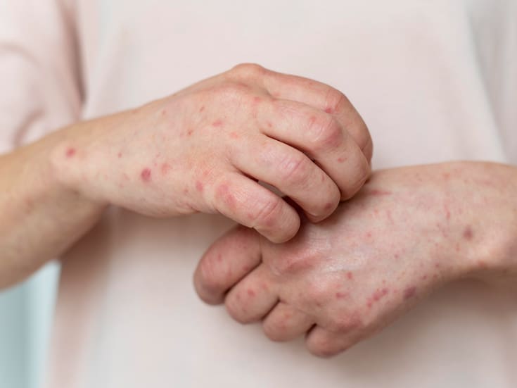 Casos de sarampión superan los mil en EEUU por tercera vez en 26 años: qué está pasando y cómo protegerse