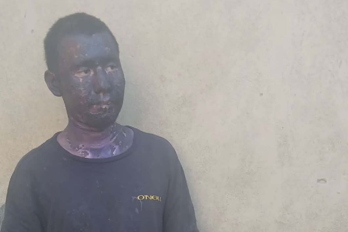 Piden apoyo para joven que resultó con quemaduras tras ataque en San Quintín