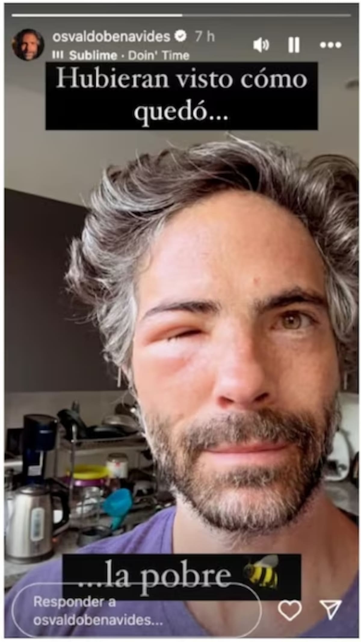 Osvaldo Benavides muestra con humor la hinchazón de su rostro. / Captura de Pantalla: IG @osvaldobenavides