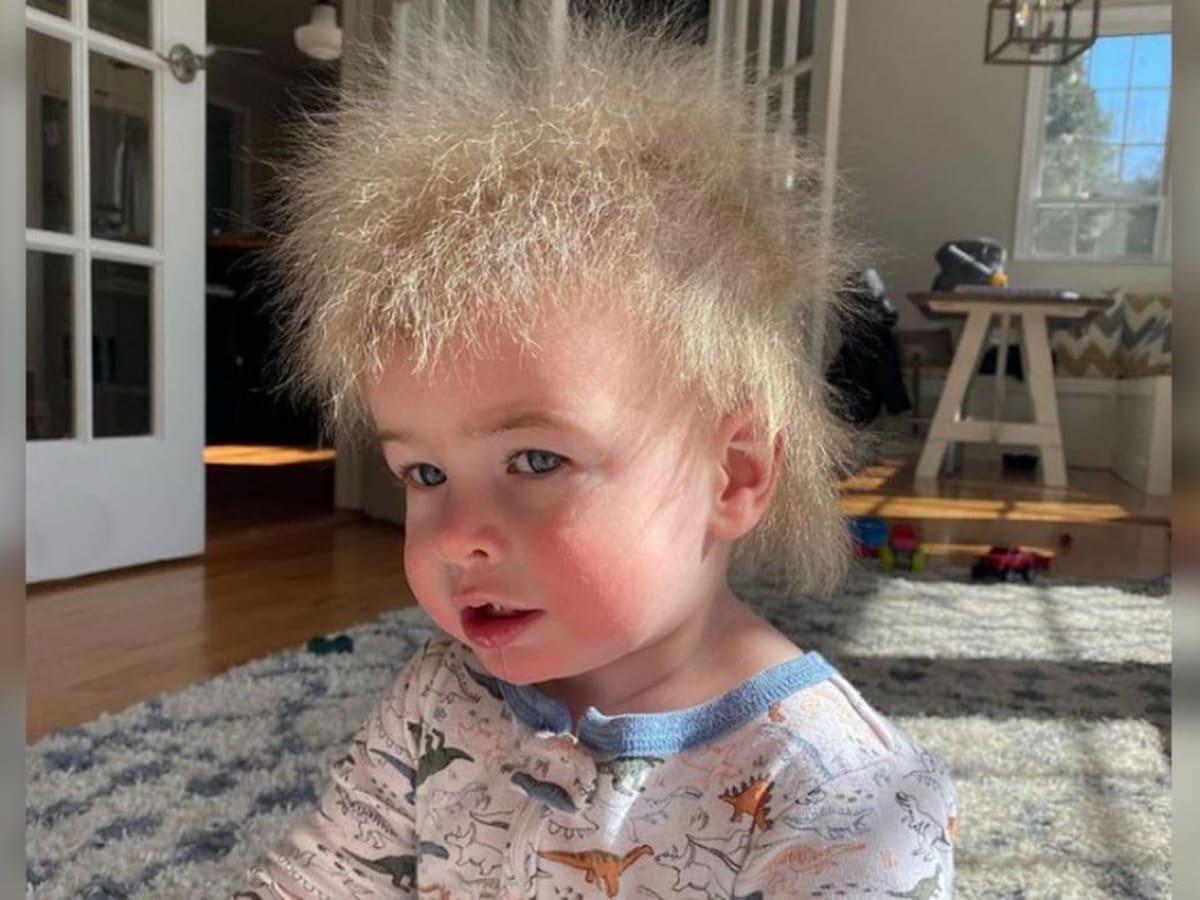 Niño con síndrome del cabello impeinable.