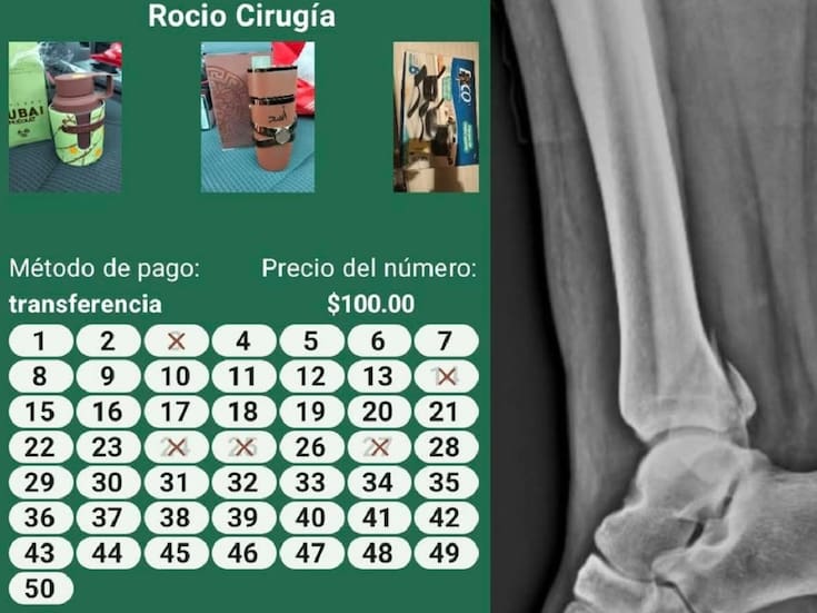 Enfermera invita a rifa operarse el tobillo