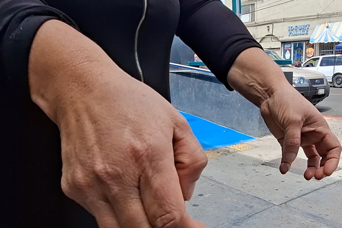 Por presunta negligencia teme perder movilidad de sus manos