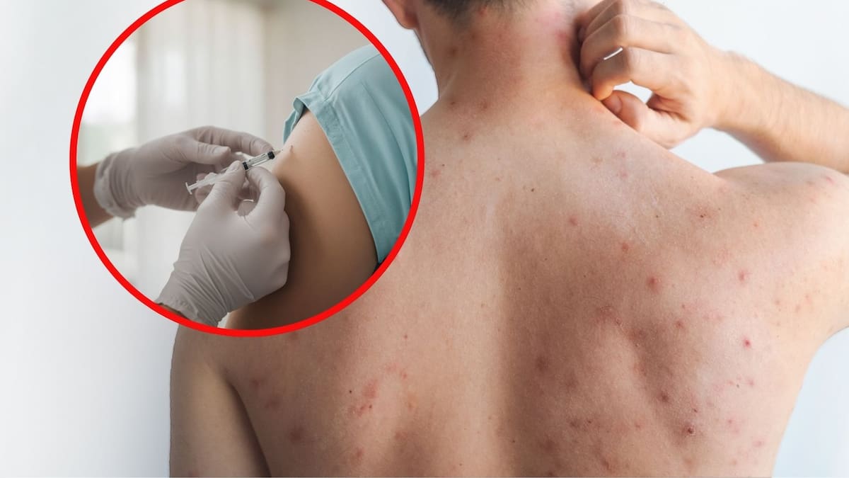 ¿Necesitas refuerzo contra el sarampión si ya tienes dos dosis? Autoridades explican reglas oficiales ante brote con 79 nuevos contagios y campaña nacional de vacunación