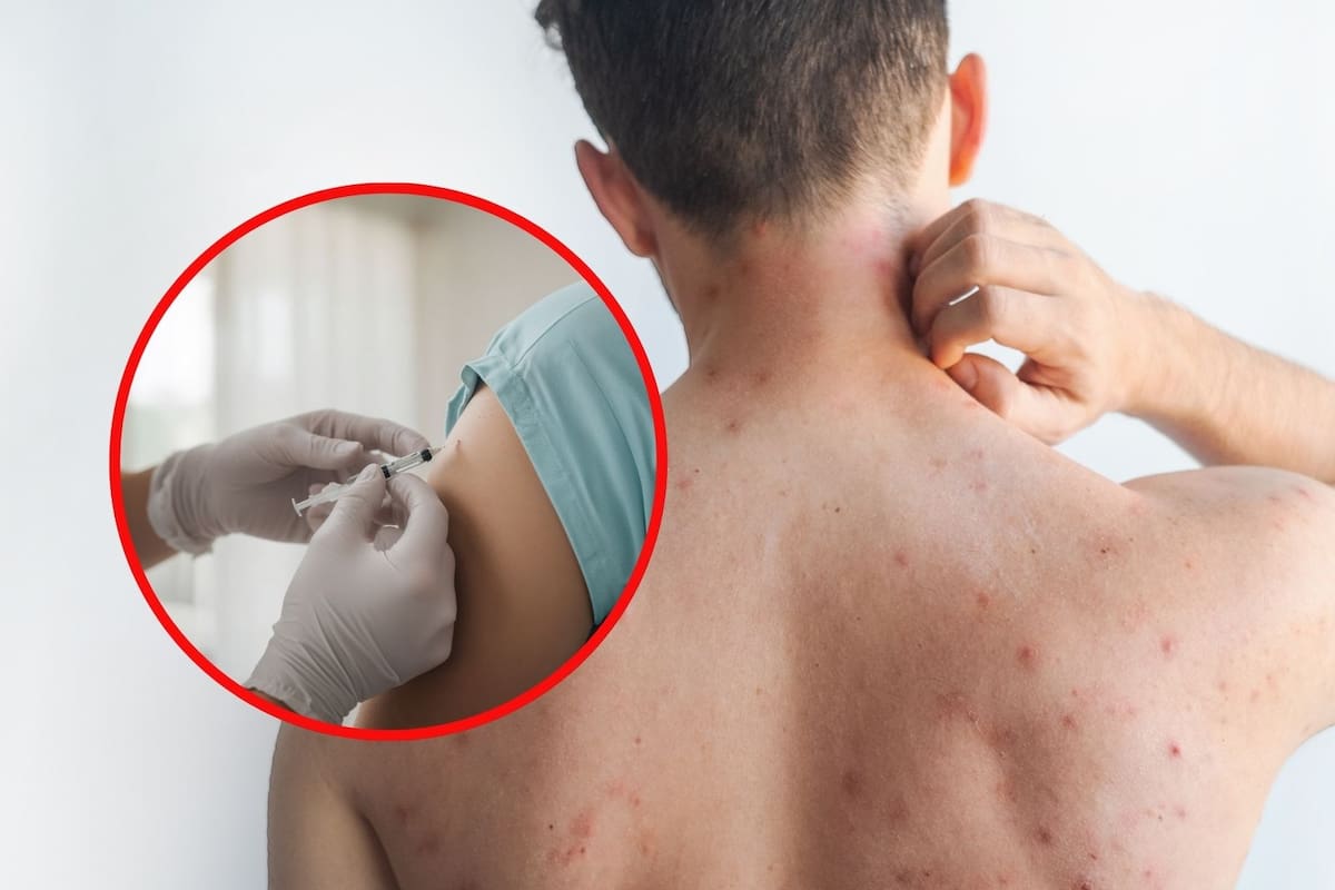 ¿Necesitas refuerzo contra el sarampión si ya tienes dos dosis? Autoridades explican reglas oficiales ante brote con 79 nuevos contagios y campaña nacional de vacunación