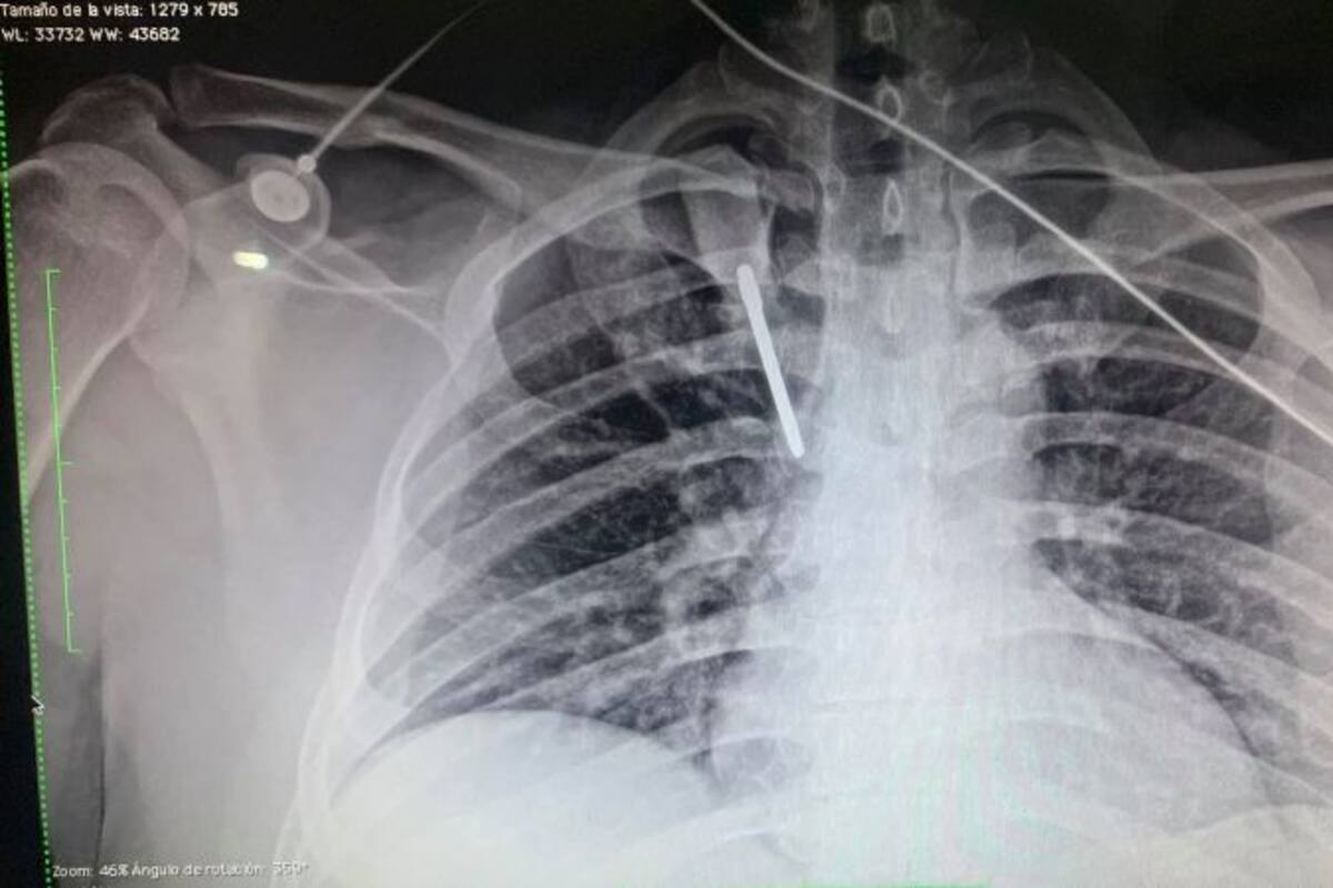 Clavan desarmador en el pecho a médico durante asalto en Nuevo León