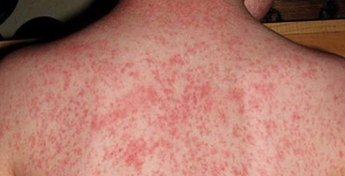 Según los CDC, el sarampión fue declarado eliminado en el año 2000, pero ha resurgido lentamente a lo largo de los años. FOTO: Facebook