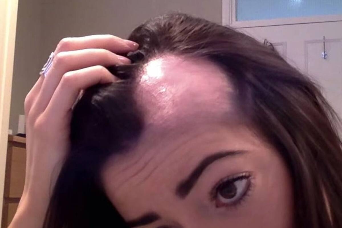 ¿A qué se debe la alopecia? ¿Hay manera de tratarla?