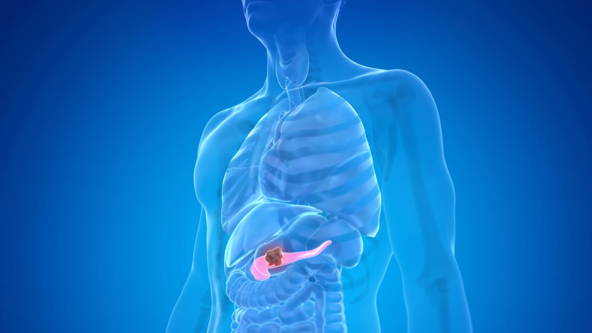 La terapia experimental logró detectar y eliminar lesiones precancerosas, retrasando el desarrollo del cáncer de páncreas y mejorando la supervivencia en modelos preclínicos.