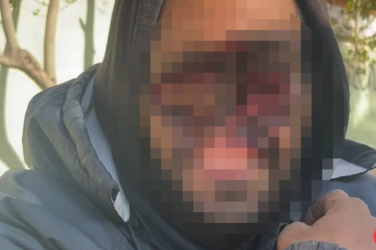 Buscan a paciente que está perdiendo el rostro por problemas de adicción y lesiones por quemaduras