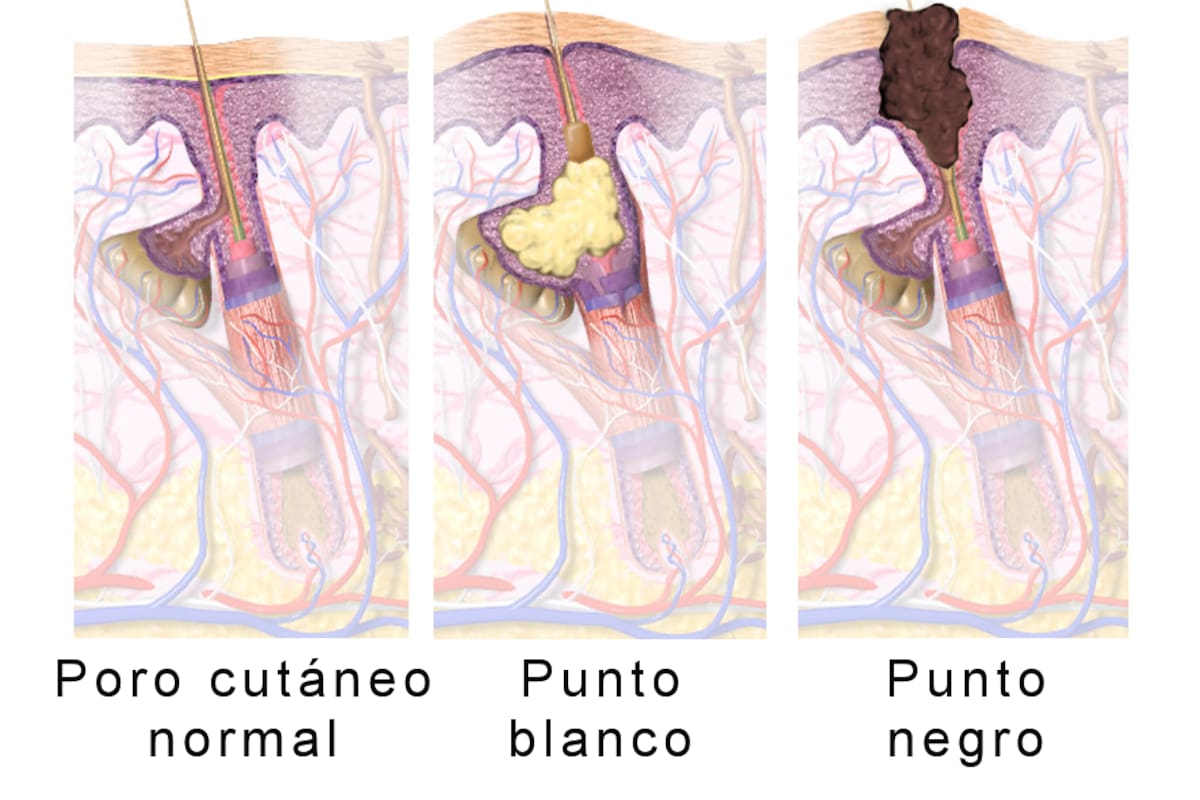 Cómo quitar los puntos negros de la nariz