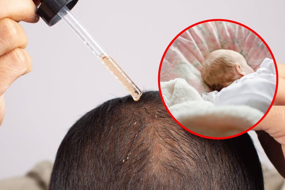 Detectan casos de “síndrome del hombre lobo” en bebés de padres que usaban minoxidil