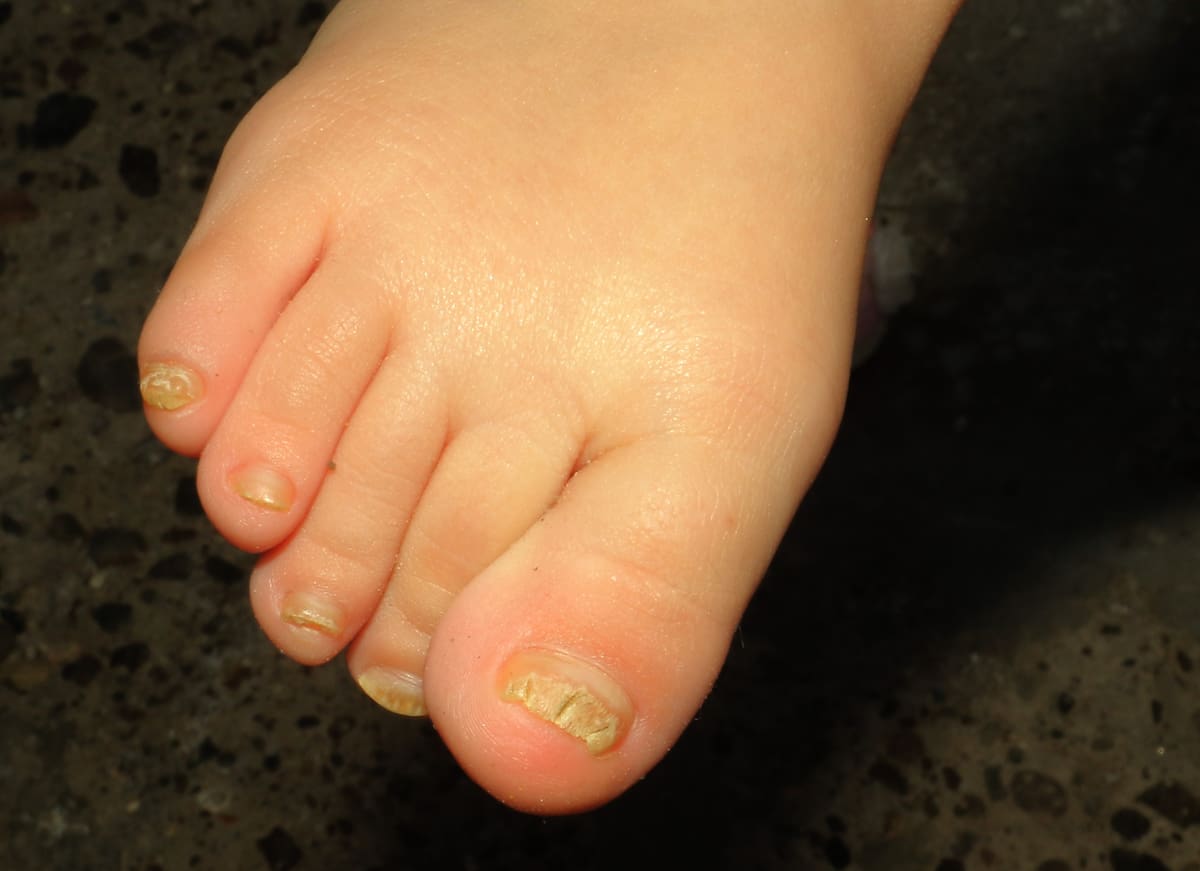 Hongos en las uñas de los pies | Archivo GH