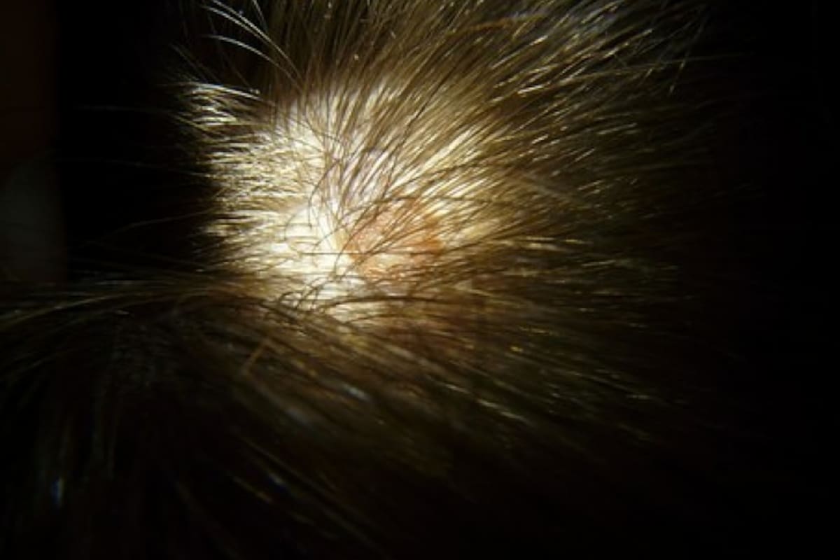 ¿Cómo tratar los granos de la cabeza?