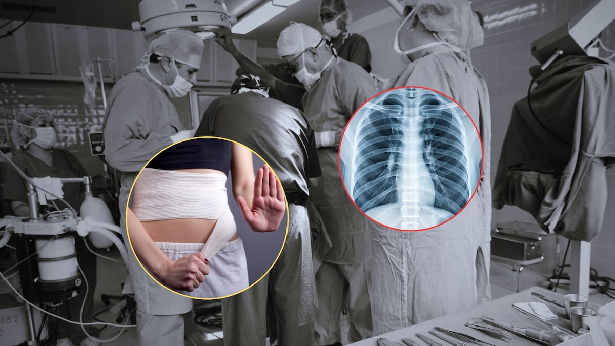 Una nueva cirugía estética para adelgazar la cintura está ganando popularidad, a pesar de su drástico procedimiento de romper y sacar las costillas