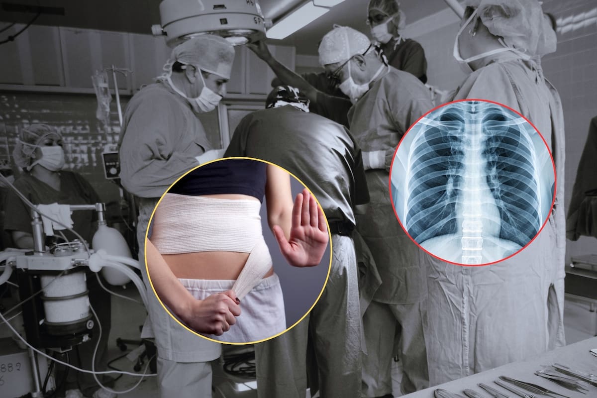 Una nueva cirugía estética para adelgazar la cintura está ganando popularidad, a pesar de su drástico procedimiento de romper y sacar las costillas
