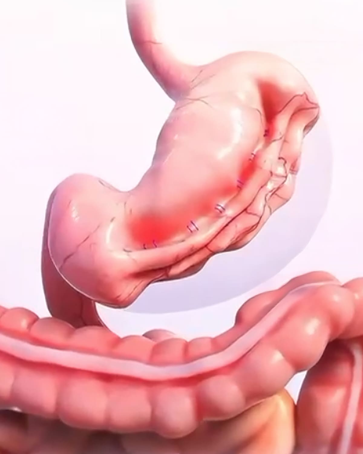 La manga gástrica por endoscopia es una técnica ambulatoria que reduce el estómago. Foto: Cortesía