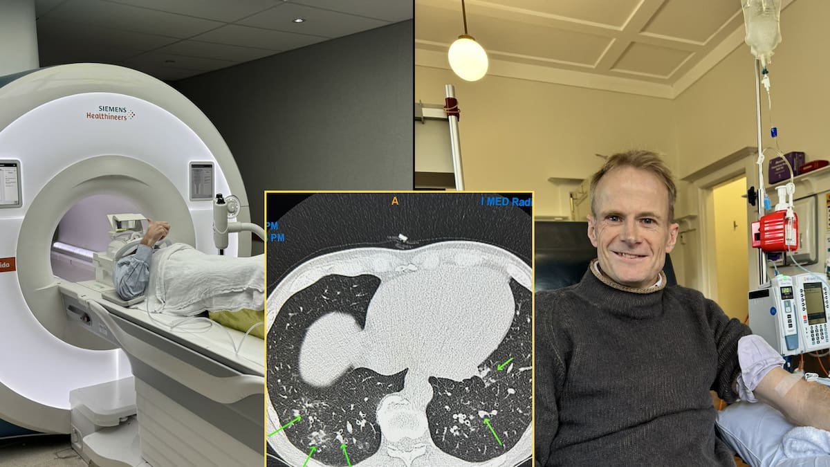 Doctor con cáncer terminal se somete a su propio tratamiento único en el mundo y se recupera por completo