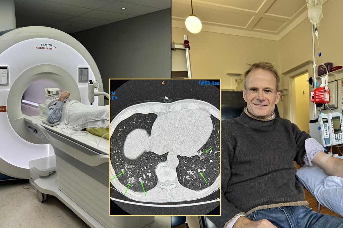 Doctor con cáncer terminal se somete a su propio tratamiento único en el mundo y se recupera por completo