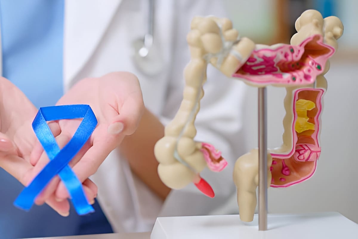 Aumento del cáncer de colon en adultos jóvenes preocupa a la comunidad médica