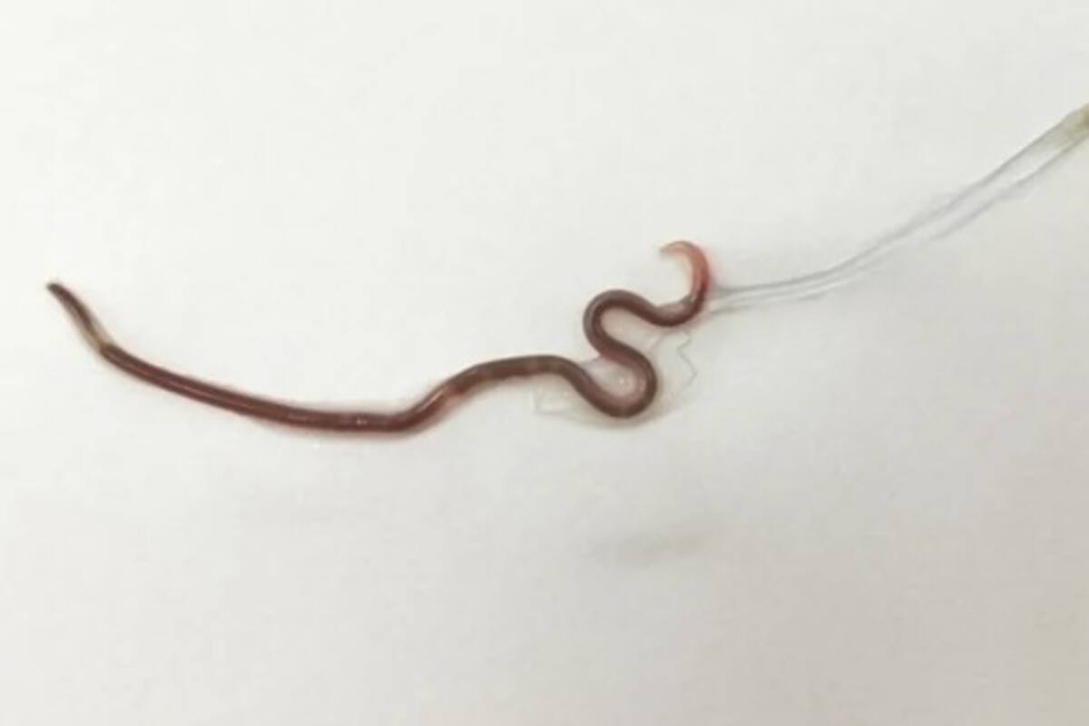 Encuentran gusano de 38 milímetros en la amígdala de una mujer que comió sashimi
