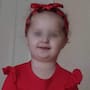 Niña de 3 años muere por piojos luego de que sus padres permitieran que la infestación empeorara tanto que le provocó anemia