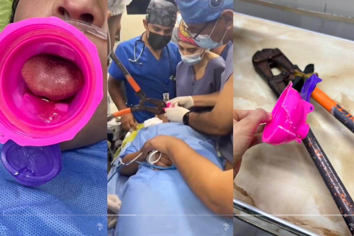 VIDEO | Niña sufre curioso accidente: se le queda atorada la lengua en la tapa de una botella