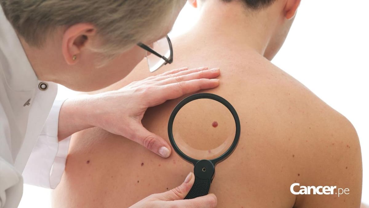 Un 15% de las personas que acuden a revisión son diagnosticadas con cáncer de piel.