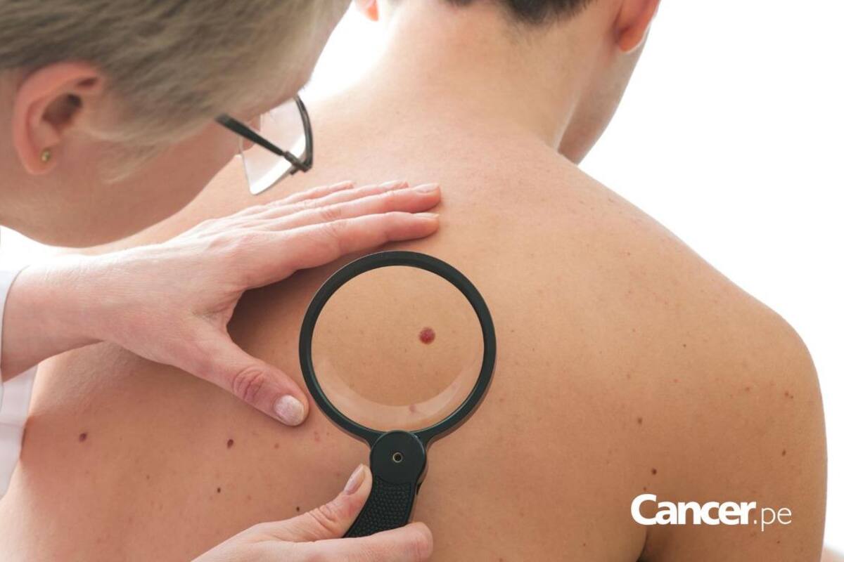 Expertos explicarán todo sobre el cáncer de piel