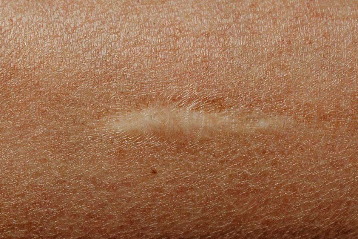 ¿Por qué las cicatrices no se quitan? Esto dice la ciencia