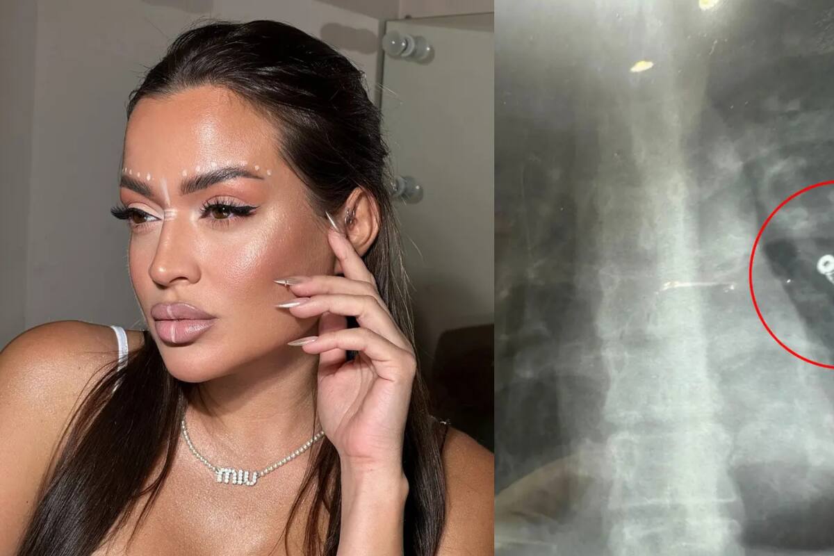 Influencer pensó que tenía un resfriado, pero una radiografía reveló un error quirúrgico previo: “Dijeron que podía morir en cualquier momento”