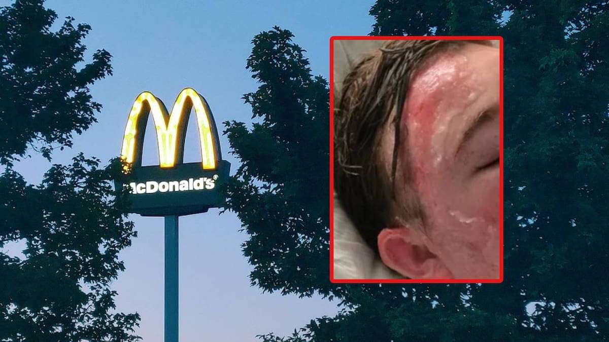 Jacob, un joven empleado de McDonald’s en California, queda hospitalizado tras presunto ataque con aceite caliente de un compañero en su rostro; piden apoyo a través de plataformas