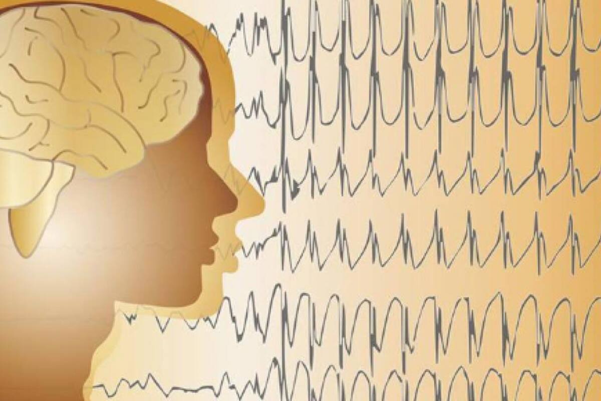 ¿Qué es el síndrome Lennox Gastaut?
