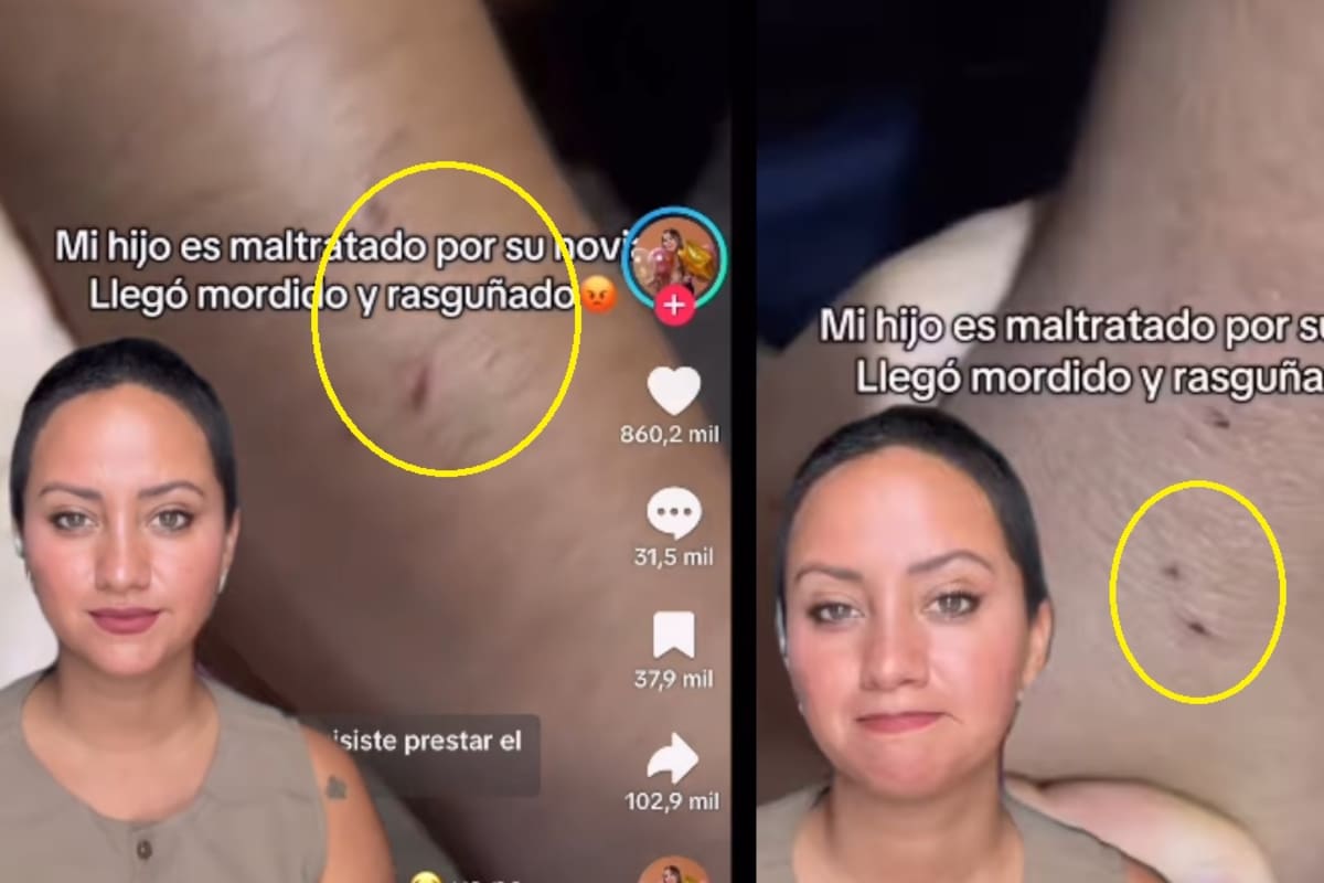 “Llegó con los brazos rasguñados y mordidos”: Madre muestra cómo su hijo regresó maltratado de una salida con su novia y desata indignación en redes sociales