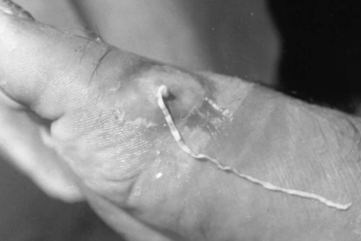 Extraño parásito casi extinto que vive dentro del cuerpo humano podría haber resurgido