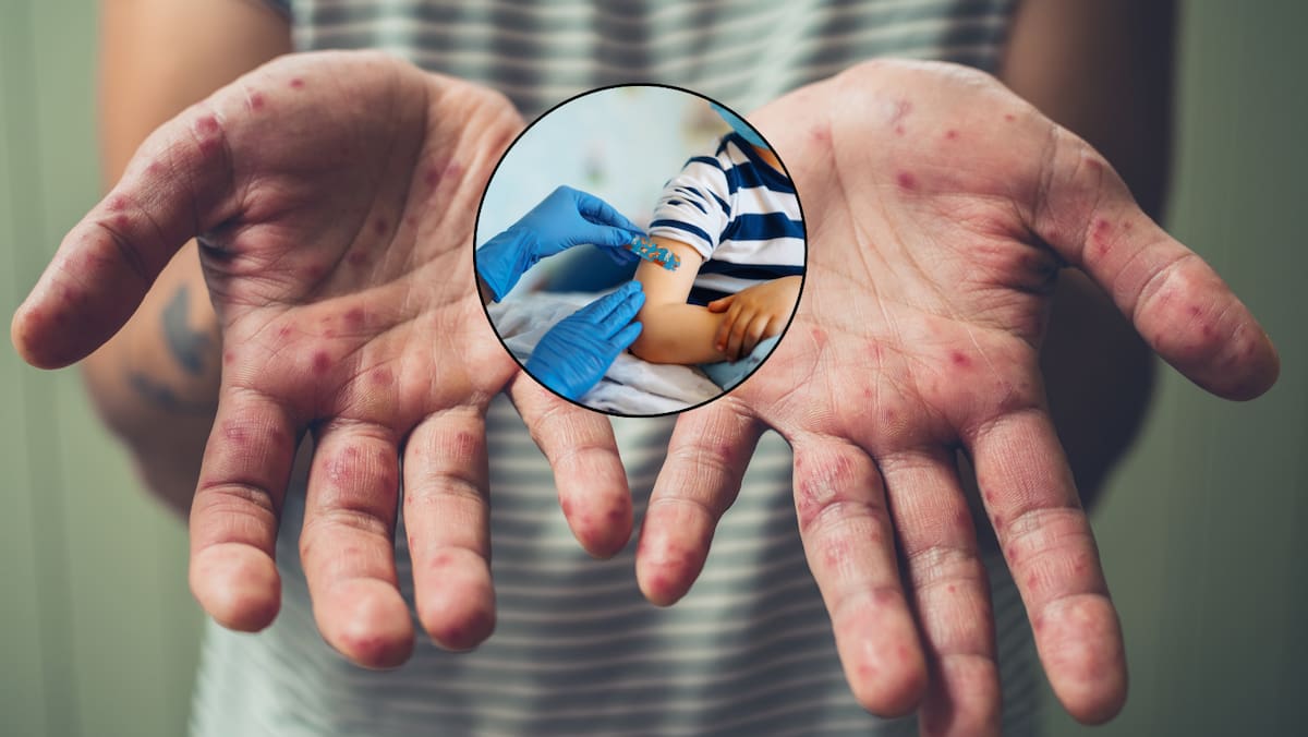 Sarampión: Descubre cómo prevenirlo, reconocerlo a tiempo y proteger a tu familia