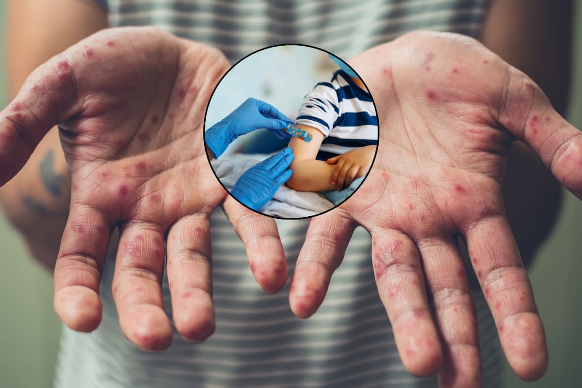 Aumentan casos de sarampión en México: ¿cómo se contagia, cuáles son sus complicaciones y cuál es la mejor manera de protegerte a ti y a tu familia?