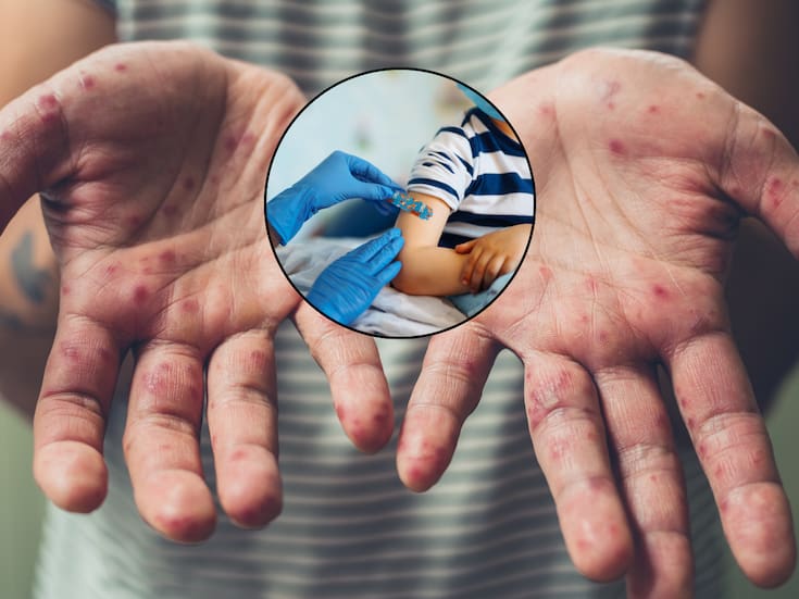 Aumentan casos de sarampión en México: ¿cómo se contagia, cuáles son sus complicaciones y cuál es la mejor manera de protegerte a ti y a tu familia?