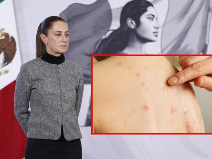 Casos de sarampión no ceden en México; autoridades advierten que es uno de los virus más contagiosos y refuerzan llamado a vacunarse