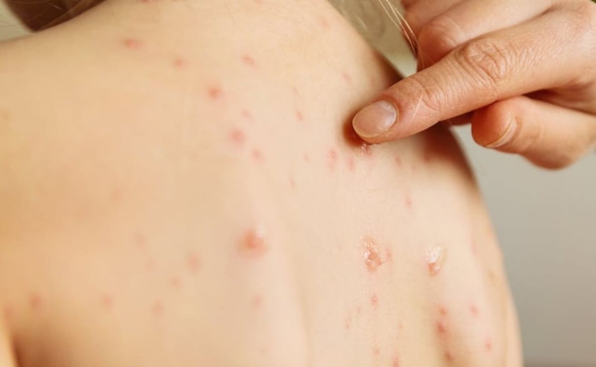 El secretario destacó que los casos se concentran en los mismos estados que dio a conocer la semana pasada, entre ellos Jalisco.