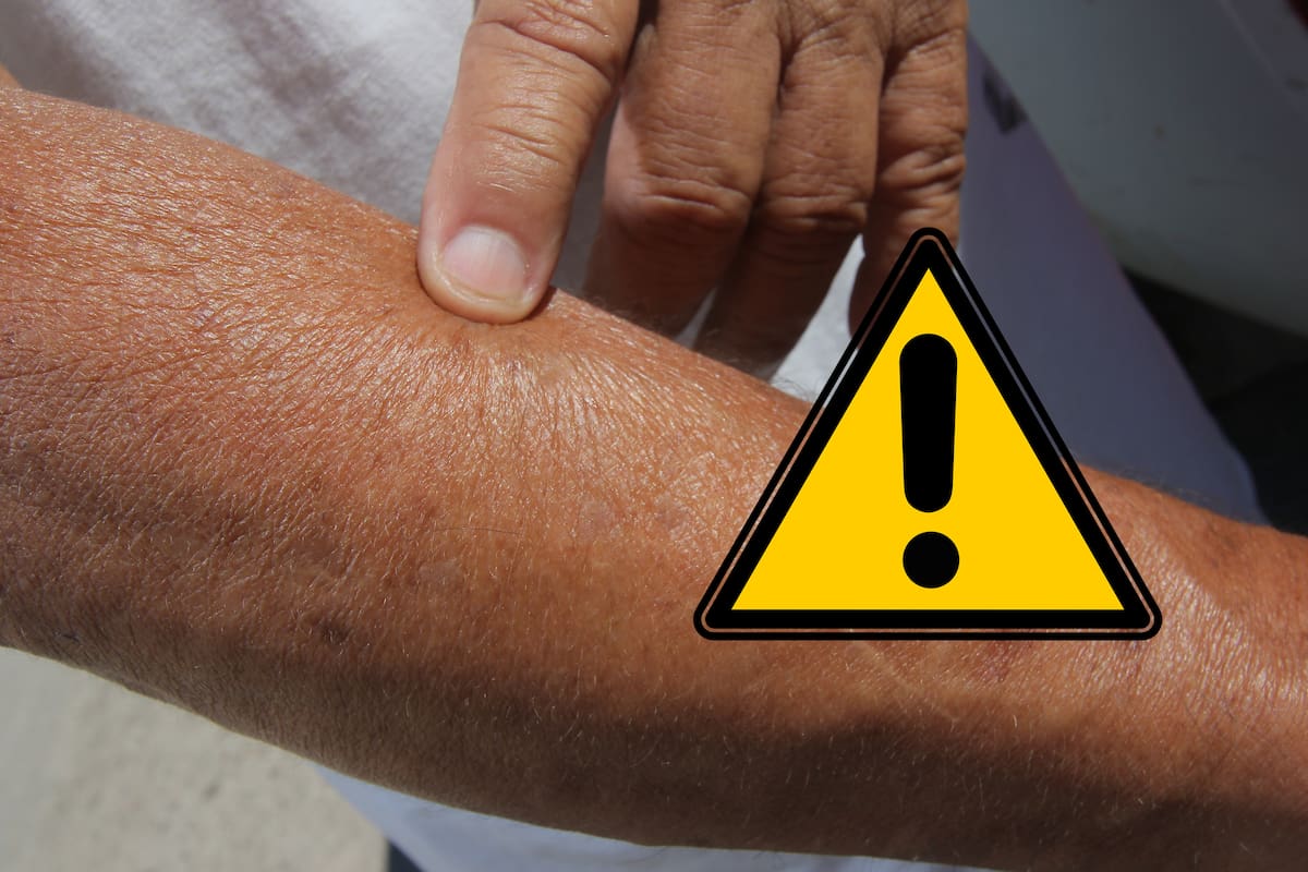 ¿Cáncer de Piel?: Recomiendan no ignorar “bolitas”, verrugas o nuevos lunares