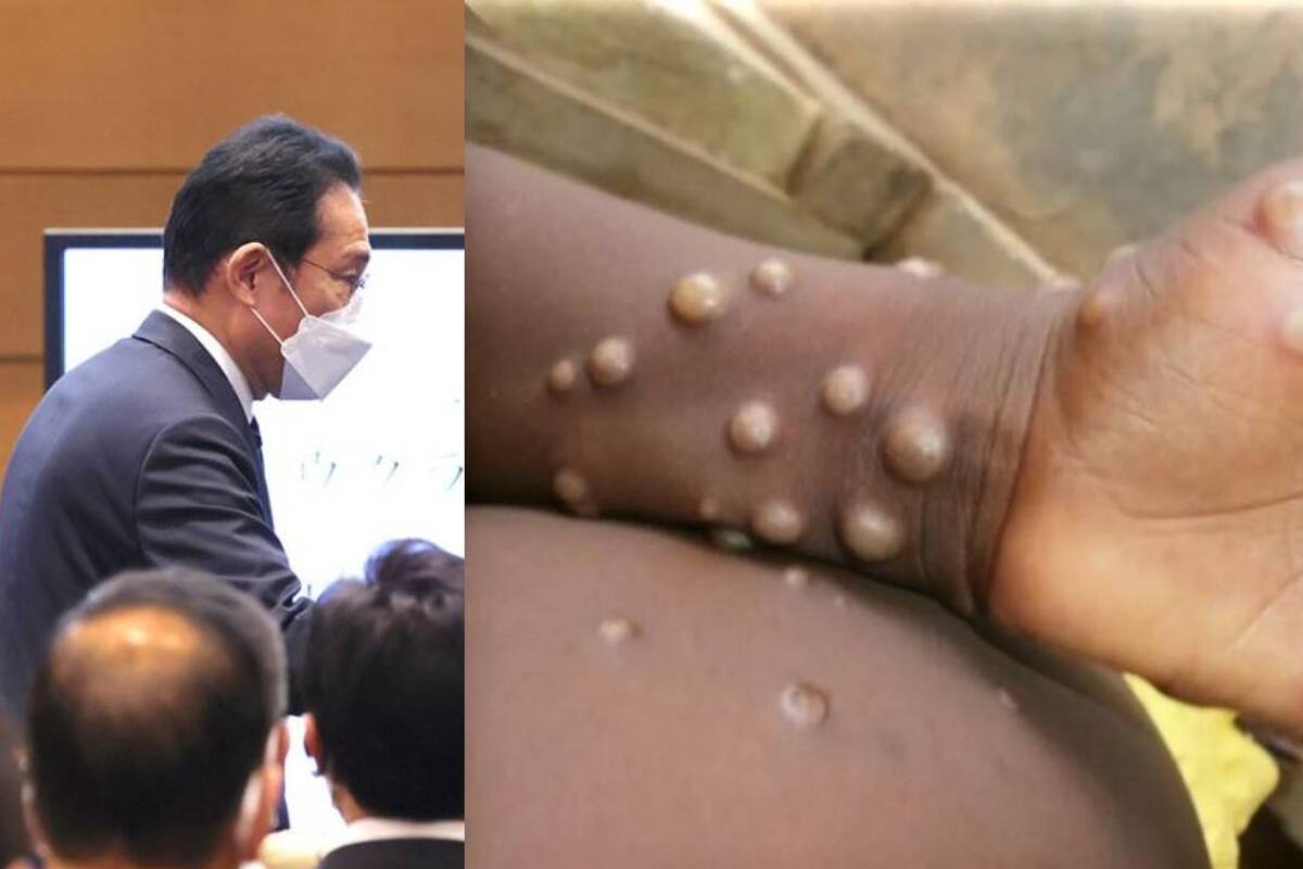 Japón: Detectan primer caso de viruela del mono