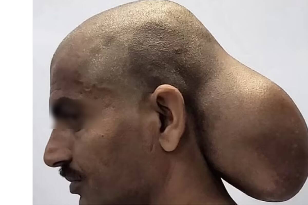 Hombre pasó 15 años con un tumor extremadamente raro del tamaño de su cabeza