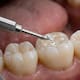 Gel podría recuperar el esmalte dental perdido