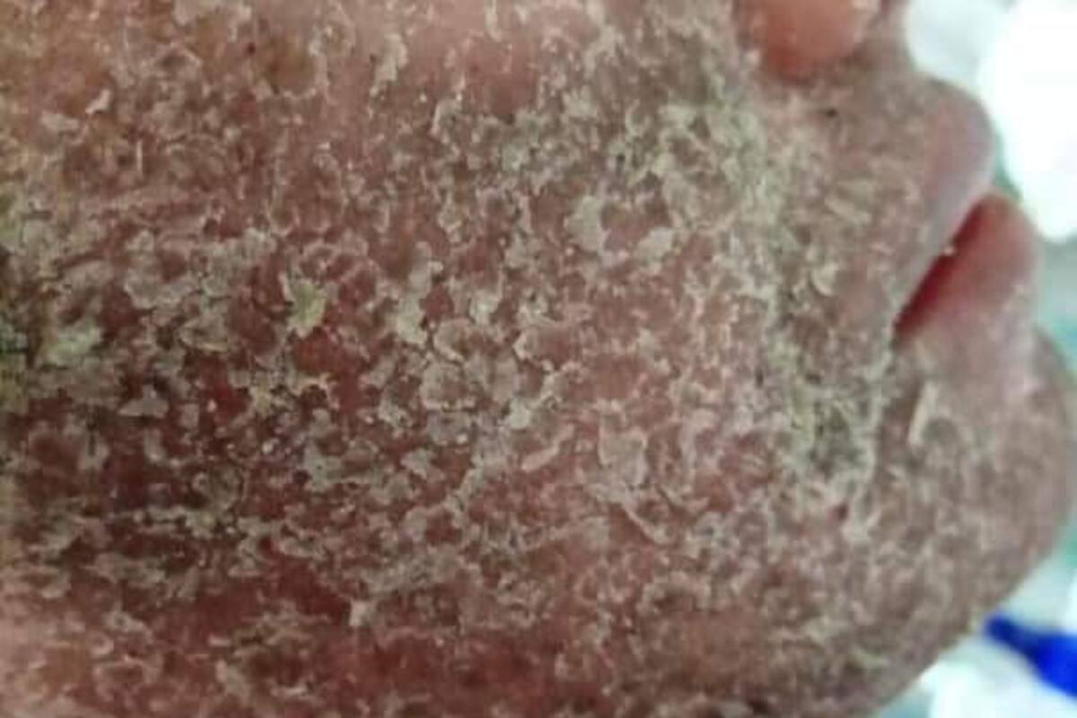 Lucha para conseguir un tratamiento para su hija que padece extraña enfermedad en la piel