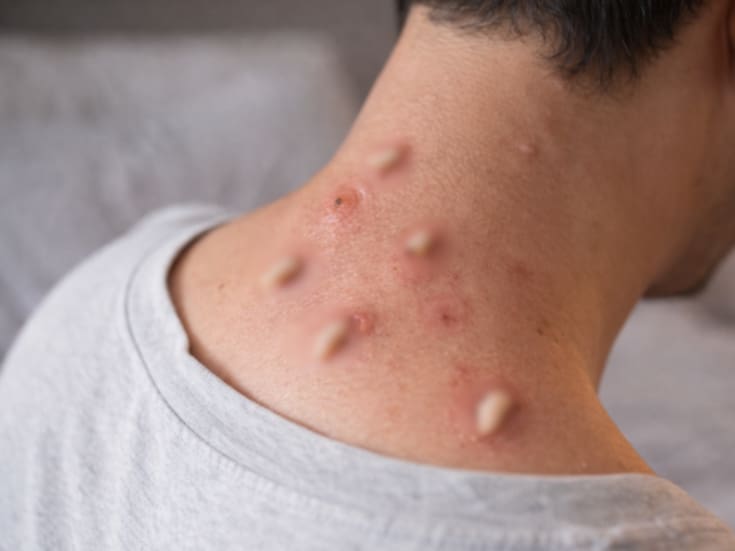 Alarma en Guerrero: Primer presunto contagio humano de gusano barrenador sacude a Copala en plena crisis ganadera