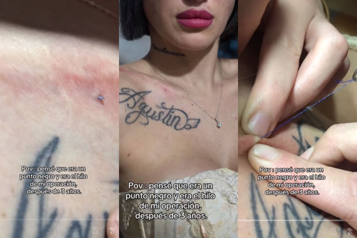 Mujer descubre un hilo de sutura olvidado debajo de su piel después de una operación de hace tres años