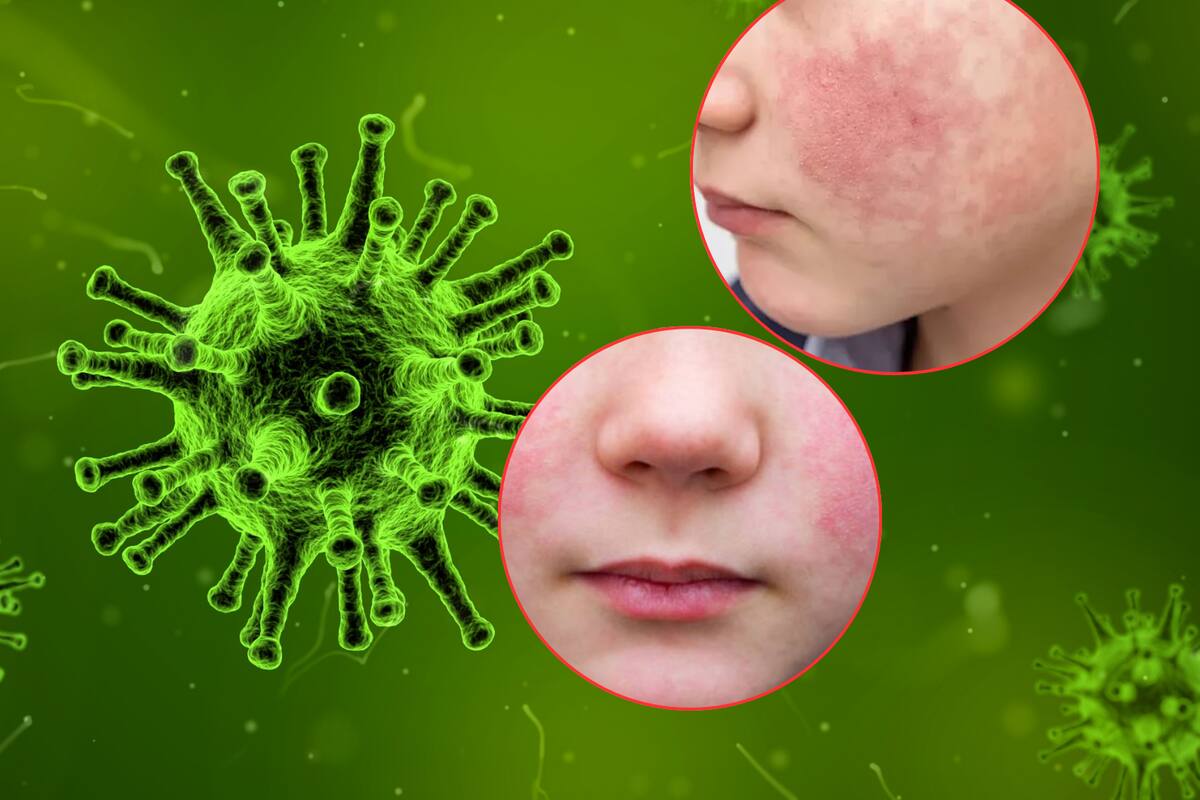 Virus de la bofetada en niños registra aumento de casos en España: ¿Cuáles son los síntomas y cómo se transmite?