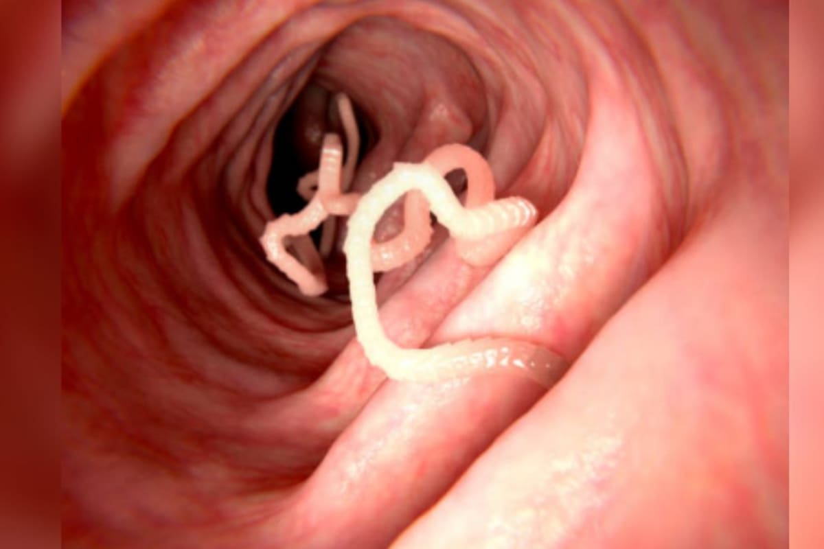 Lombrices solitarias: ¿cómo afecta la salud de los humanos?